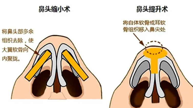 医美优质文章推荐: 鼻尖缝合方法对鼻外观的影响