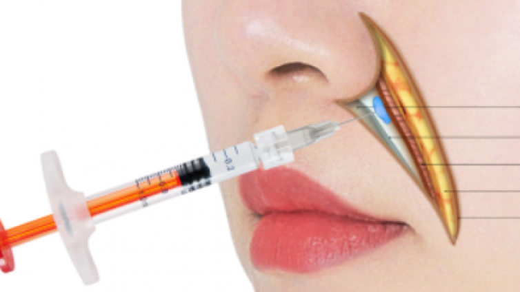 医美优质文章推荐: 鼻唇沟的解剖学分型有几种？如何实现精准诊疗？