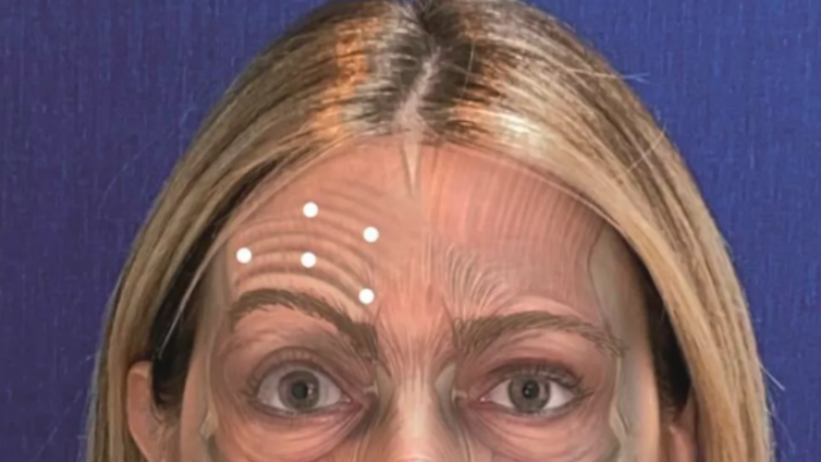 医美优质文章推荐: A型肉毒毒素在面部提拉术后对称性改善中的作用